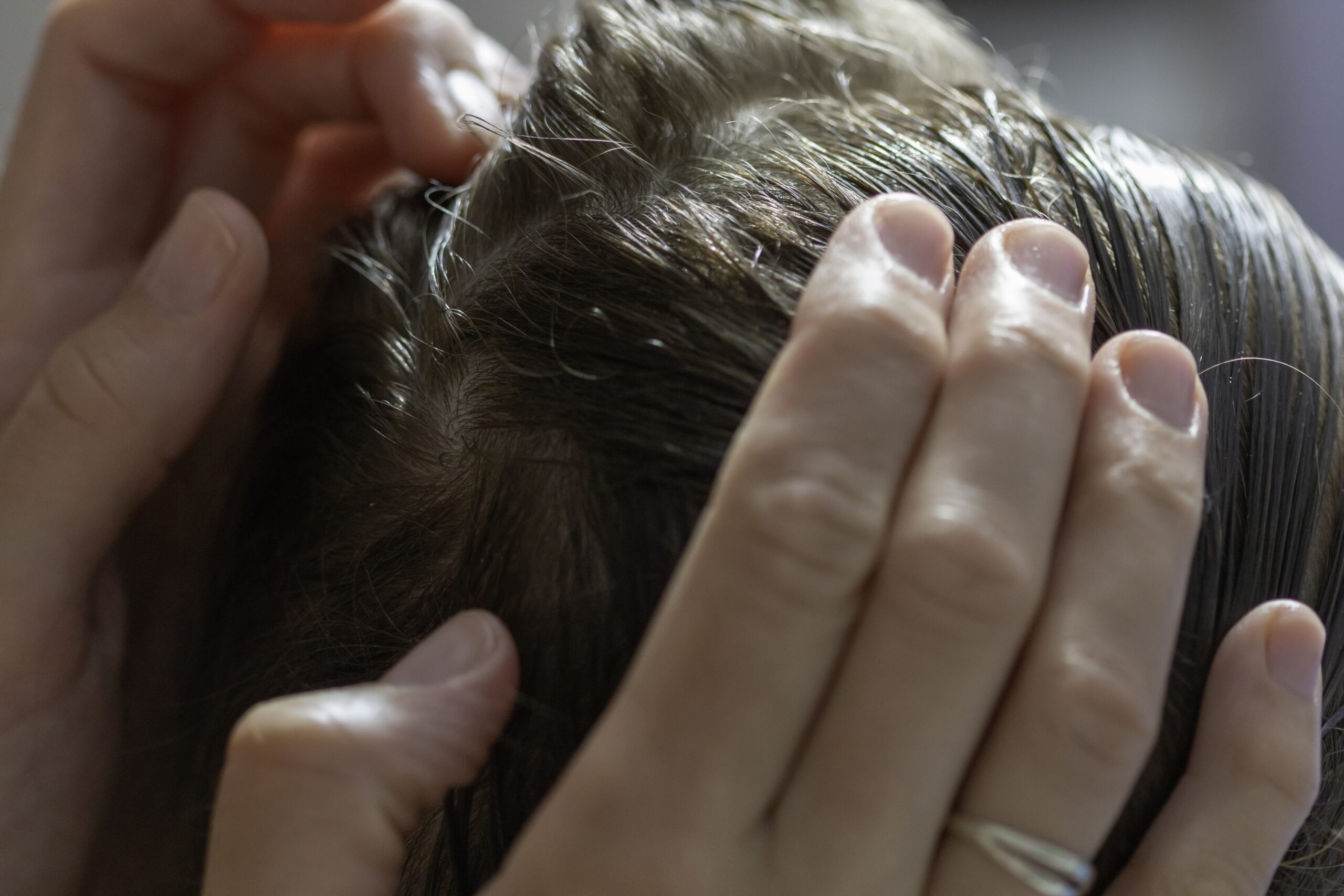 Closeup photo of hair scalp issue